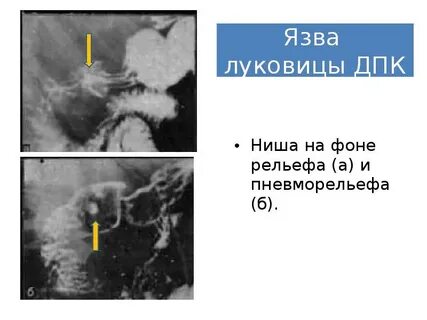 Язва луковицы мкб 10