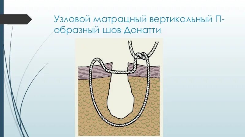 Матрацный шов в хирургии. Матрацный вертикальный п-образный шов. вертикальный матрацный узловой шов. п образный шов и матрацный шов.