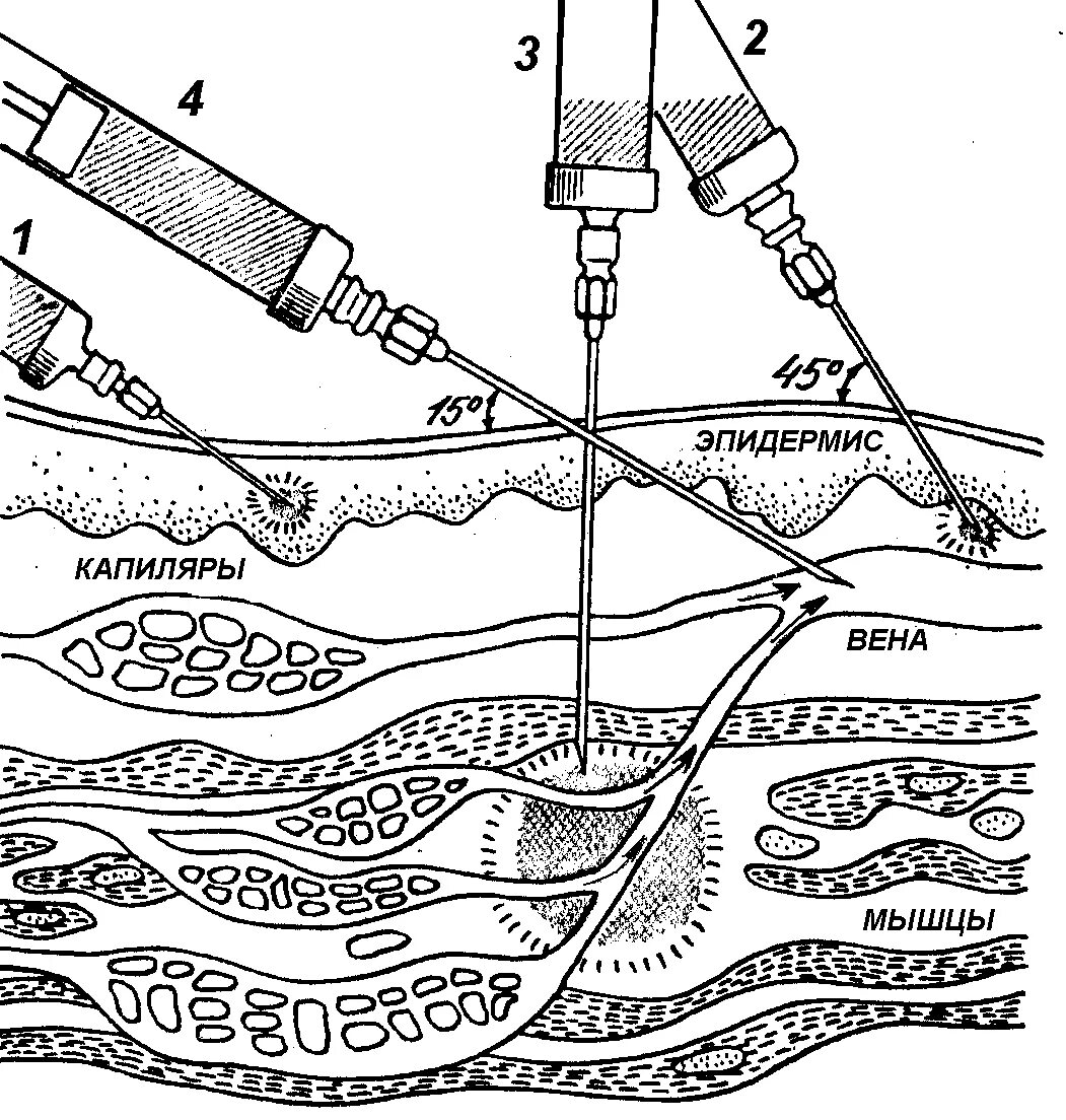 Иглу после инъекции. Угол введения иглы в Вену. Внутрикожная подкожная внутримышечная внутривенная. Алгоритм выполнения подкожной инъекции схема. Схема внутрикожного введения.