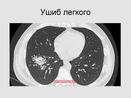 Повреждение легких