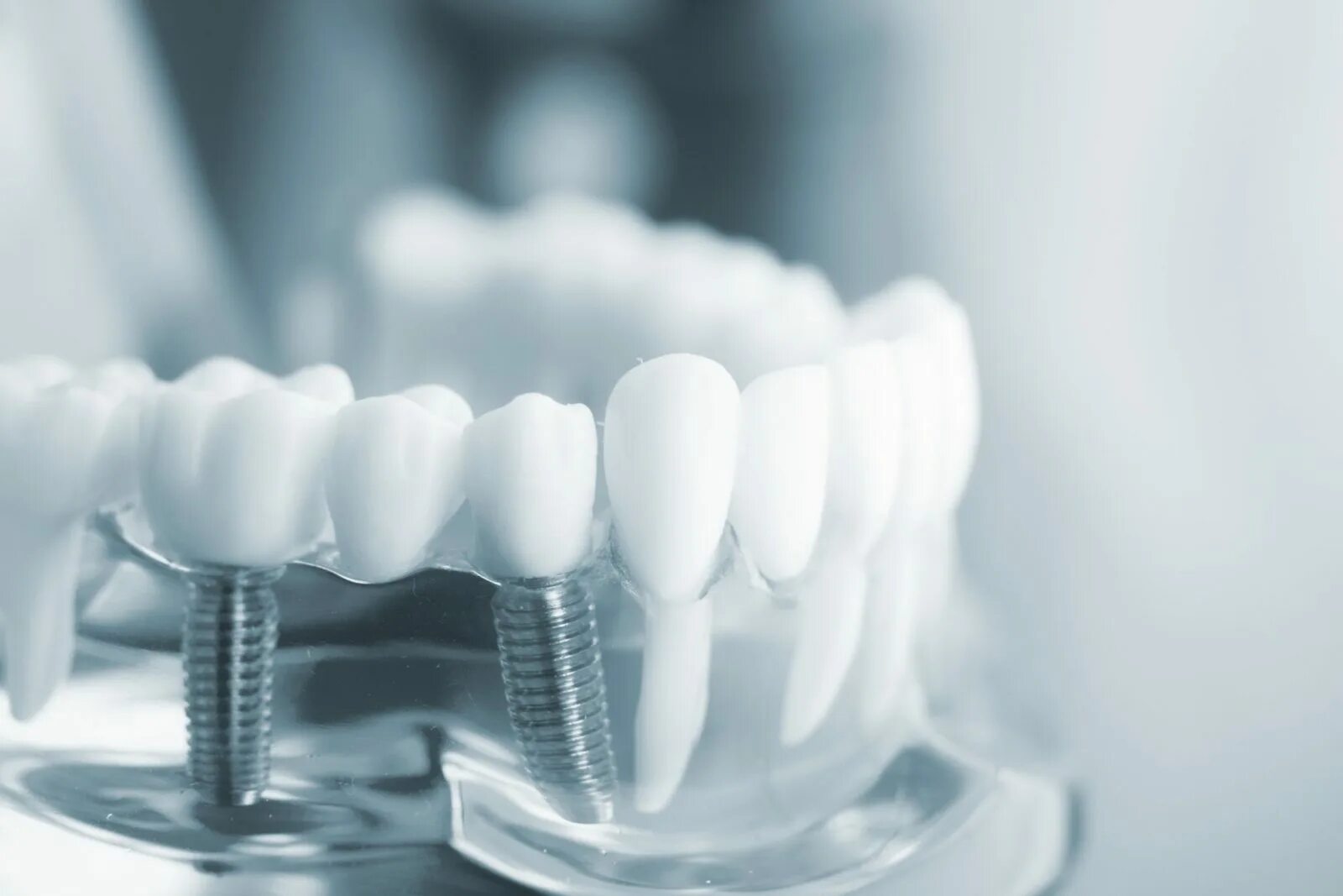 Имплантаты dentium implantium. Dental implantation. Абатмент осстем. Dental implantation. Dental implantation.