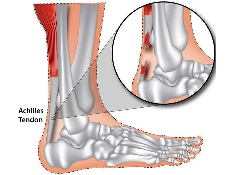 Растяжение ахиллова сухожилия. Танзенит ахилового сухожилия. Растяжение ахиллова сухожилия (тендинит).