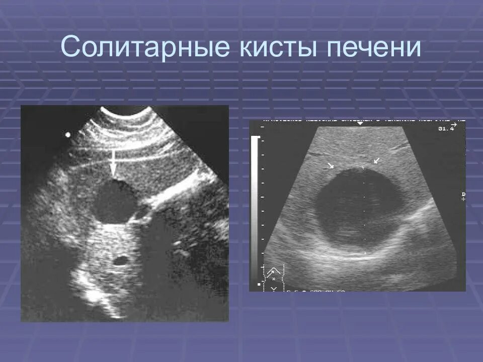 Киста на печени чем опасна у женщины. Солитарные кисты печени УЗИ. Солитарная киста печени. Многокамерная киста печени УЗИ. Паразитарные кисты печени на УЗИ.