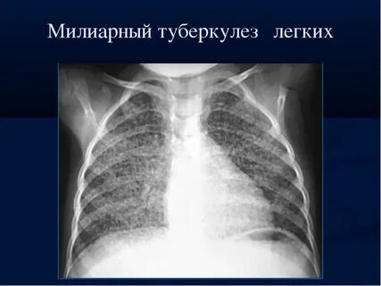 Милиарный туберкулез легких описание
