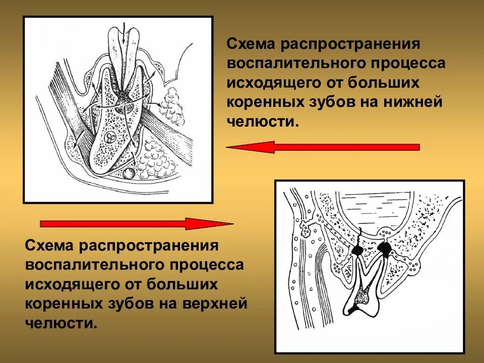 Абсцесс желобка