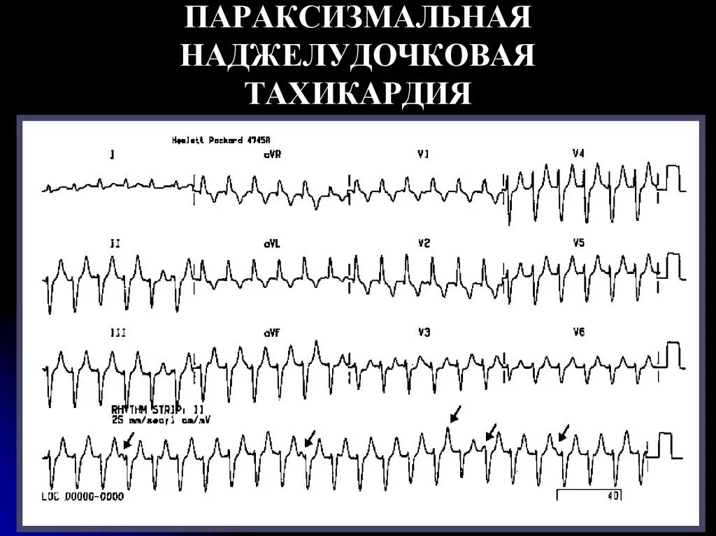 Желудочковая тахикардия на экг. Наджелудочковые тахикардии ЭКГ. Пароксизмальная наджелудочковая тахикардия ЭКГ. ЭКГ признаки наджелудочковой тахикардии. Параксизмальная наджелудочковая тахикардия.