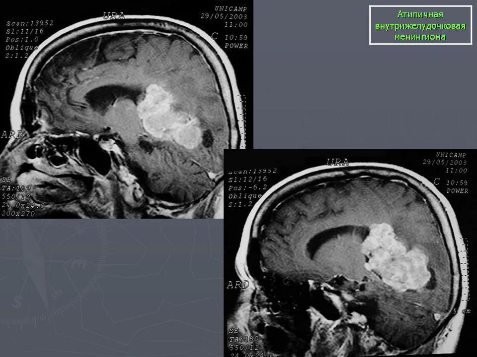 Simpson 0 менингиомы. Гемангиоперицитарная менингиома. Менингиома инвалидность. Менингиома инвалидность. Кавернозный синус менингиома кт.