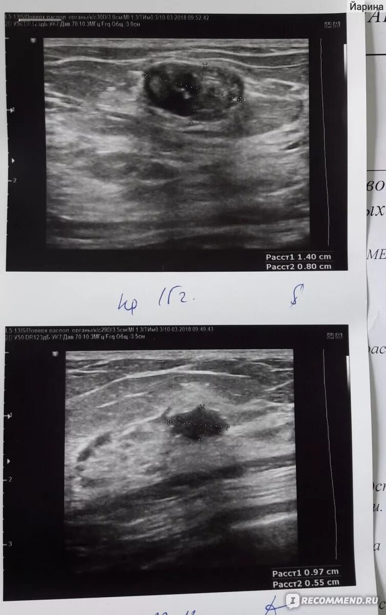Фиброаденомы форум отзывы. Фиброаденома молочной железы на УЗИ. Фиброаденома молочной железы УЗИ снимок. Фиброаденома молочной железы 13мм.