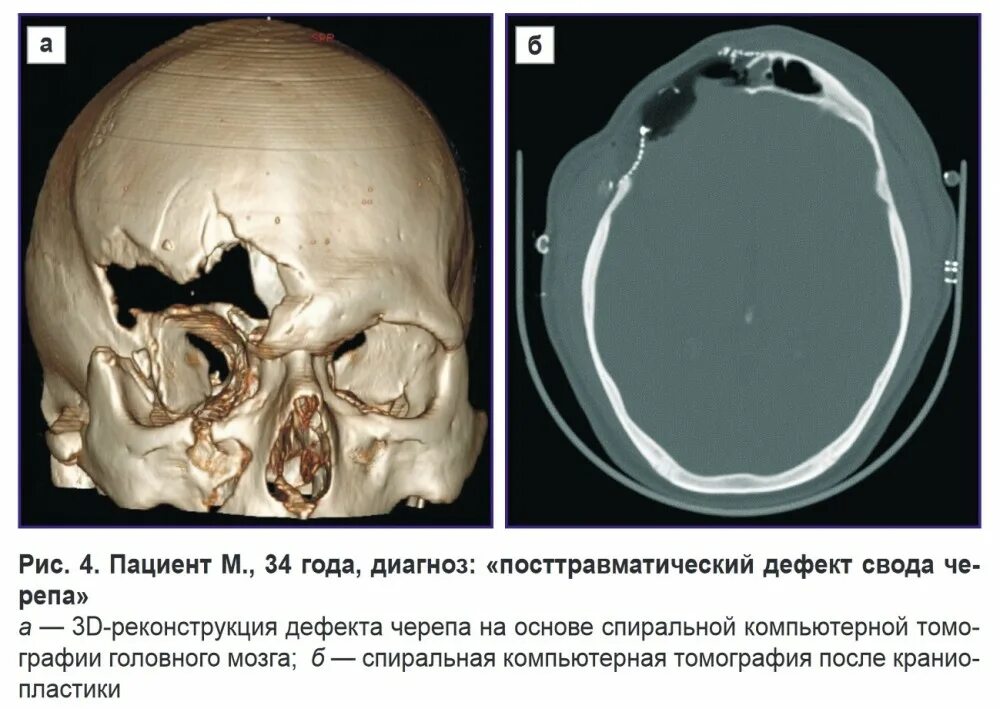 Трещина в голове. Перелом теменной кости черепа рентген. Трепанация черепа лобной кости. Краниопластика лобной кости.