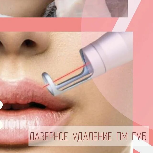 Удаление перманентного макияжа губ. Старый татуаж губ. Перманентный макияж губ. Татуаж губ после лазера. Этапы заживления пм губ.