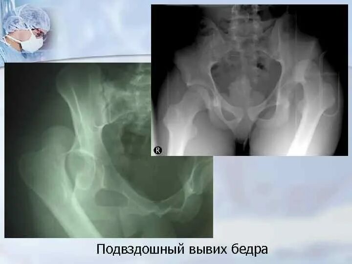 Вывих тазобедренного у взрослых. Вывих тазобедренного у взрослых