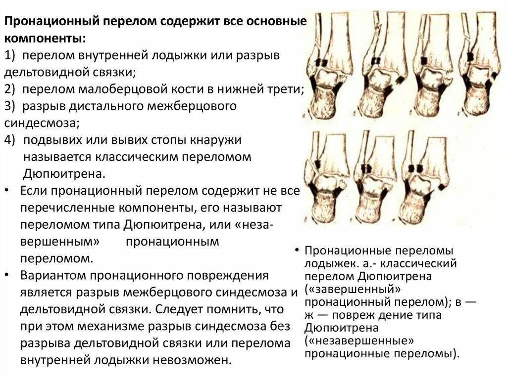 Подвывих наружной лодыжки рентген. Перелом малой берцовой кости. Подтаранный подвывих стопы. Перелом наружной лодыжки рентген протокол. Голеностопный сустав перелом малоберцовой кости.