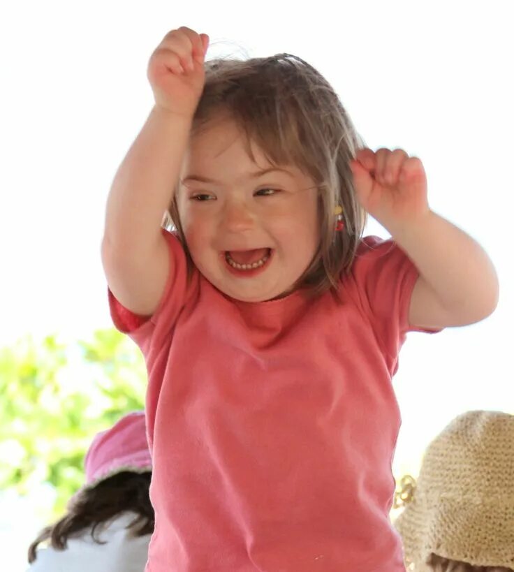 Отклонение фот. Фетальный алкогольный синдром. Черепно лицевой дисморфизм у новорожденных. Дети с нарушением развития. Отклонение фот.