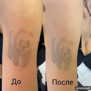 Удаление тату карбоновый пилинг