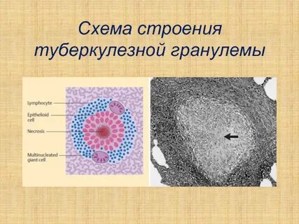 Клетки туберкулезного бугорка