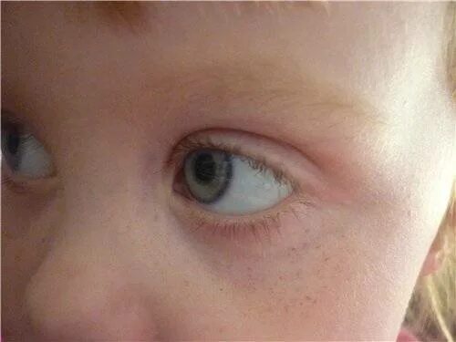 Точки около глаз. Красные пятна под глазами у ребенка. Красные точки под глазами у ребенка. Точки под глазами у ребенка. Пятнышко под глазом у ребенка.