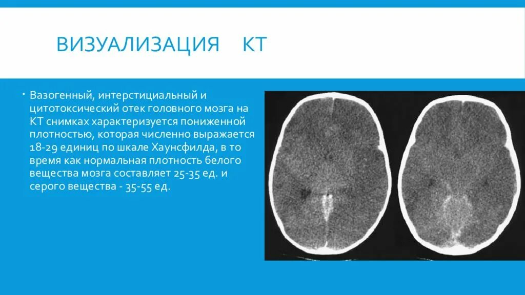 Травматический отек мозга. Плотность вещества головного мозга при кт. Отку головного мозга на кт. ОТК головного мозга накт.