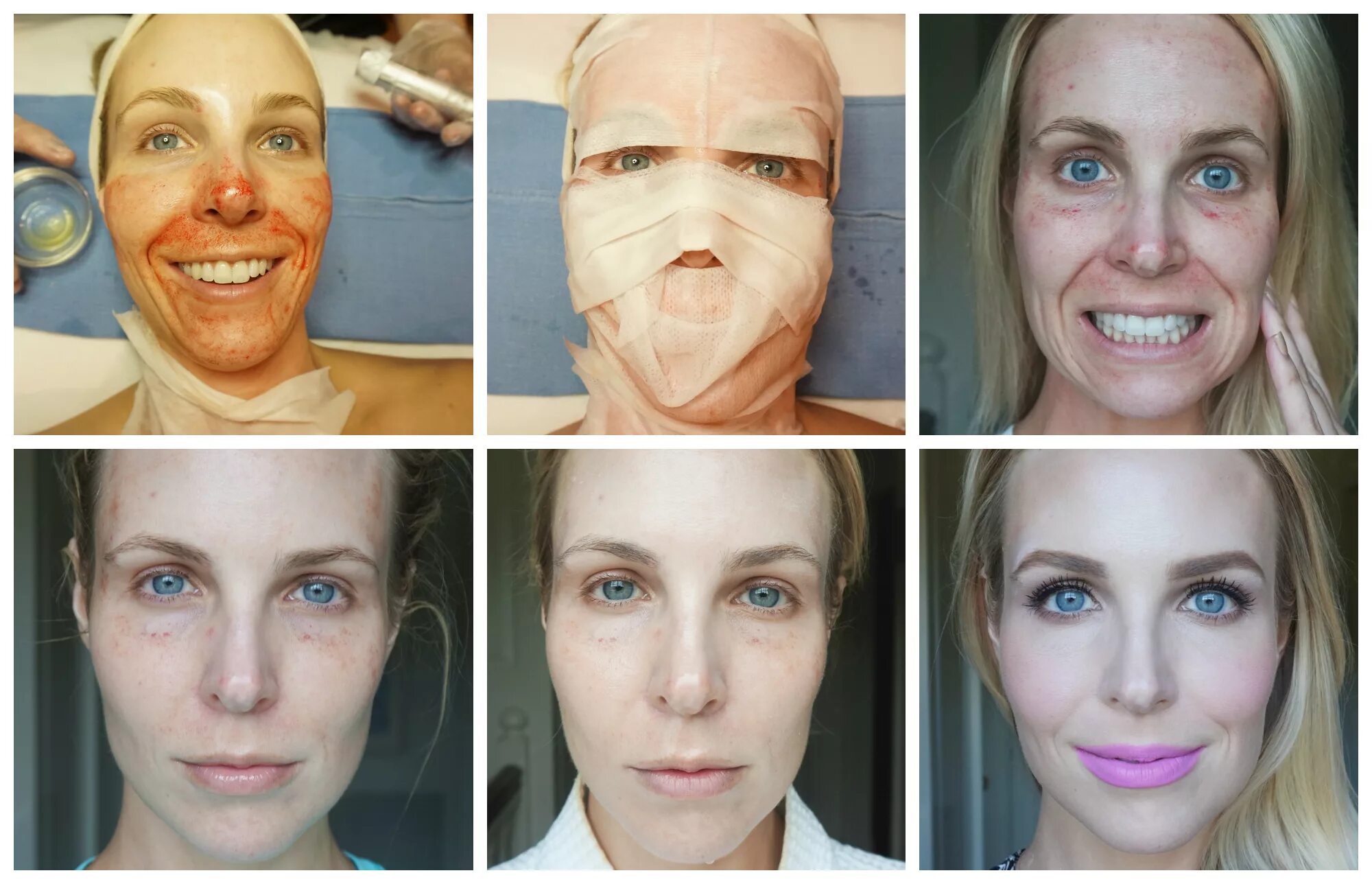 Последствия подтяжки. Плазмолифтинг для лица до и после фото. Плазмолифтинг лица до и после.