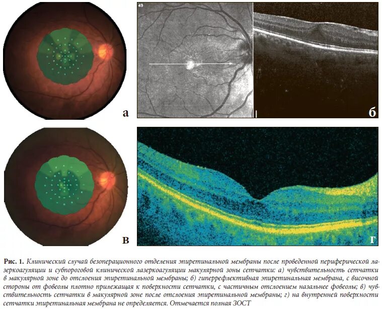 Макулярный разрыв после операции. Фиброз макулярной зоны. Эпиретинальная мембрана. Эпиретинальная мембрана сетчатки. Эпиретинальный фиброз окт.