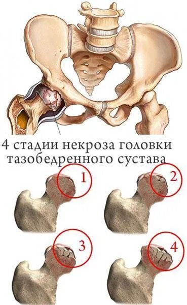 Упражнение тазобедренного сустава некроз. Некроз головки бедренной кости 4 стадии. некроз головки бедренной кости 3 стадия. стадии некроза головки бедренной кости. асептический некроз тазобедренного сустава.