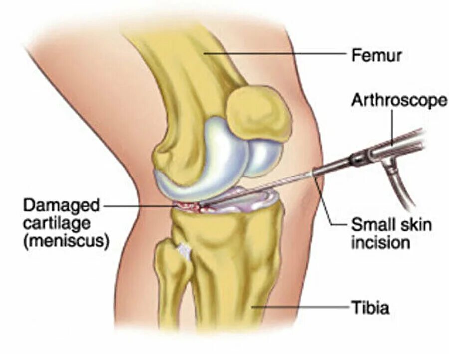 Лечение разрыва мениска коленного