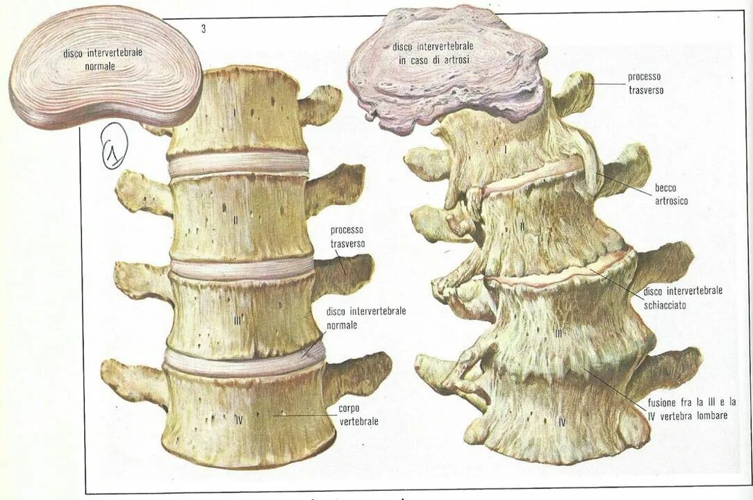 Остеофиты что это такое и как лечить. Остеофиты позвоночника поясничного. Краевые остеофиты тел позвонков поясничного отдела позвоночника. Что такое краевые остеофиты на позвоночнике. Передние краевые остеофиты.