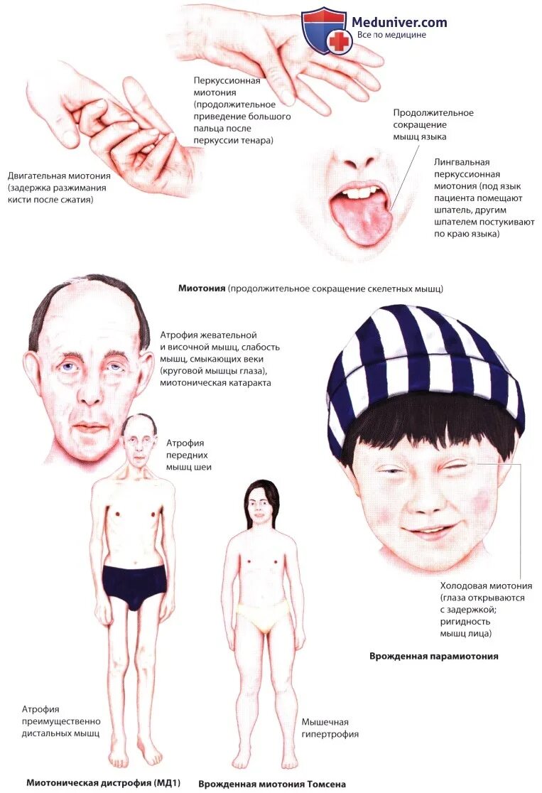 Миотония это. Миотония Россолимо Штейнерта. Врожденная миотония Томсена клинические рекомендации. Конгенитальная миотония.