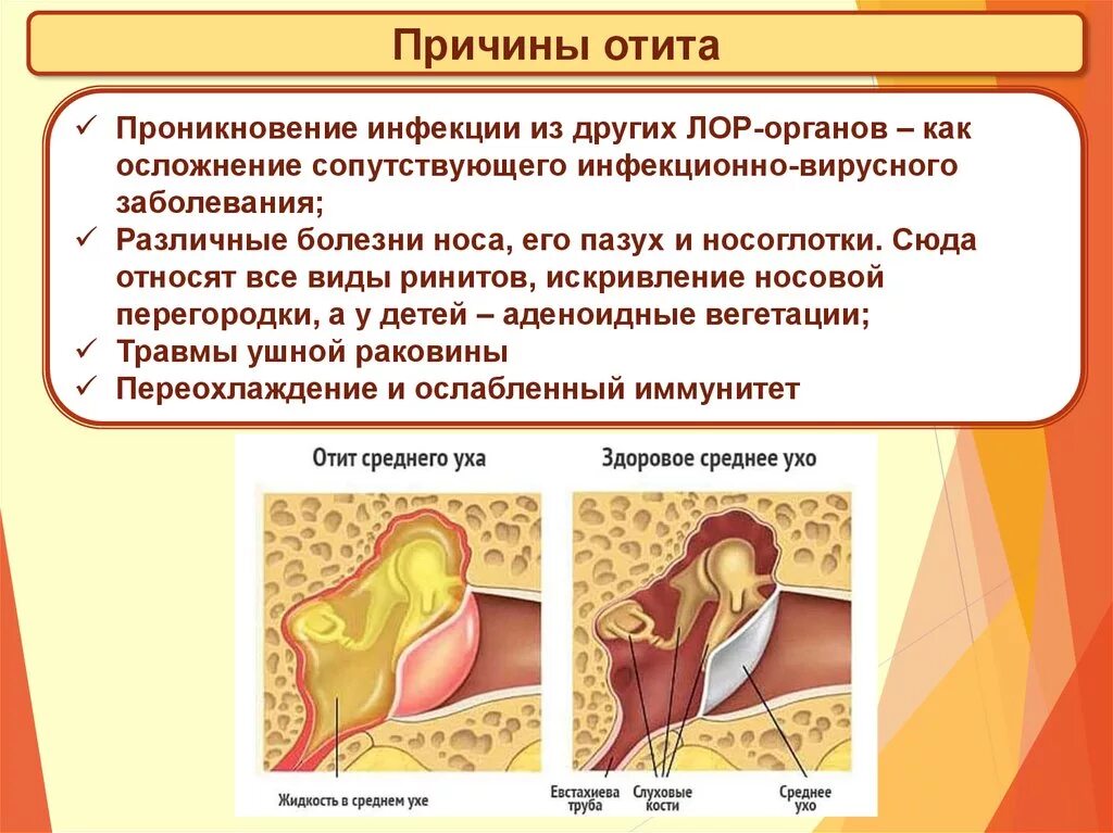 Можно ли лечить отит. Острый Гнойный средний отит профилактика. Гнойный отит наружного уха. Наружный средний Гнойный отит. Клинические симптомы отита.