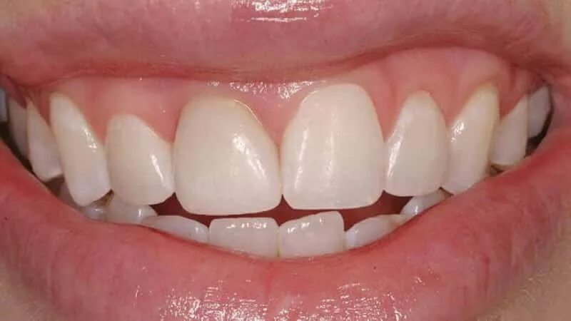 Сколько можно ходить с временными зубами
