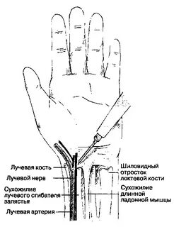 Блокада локтевого