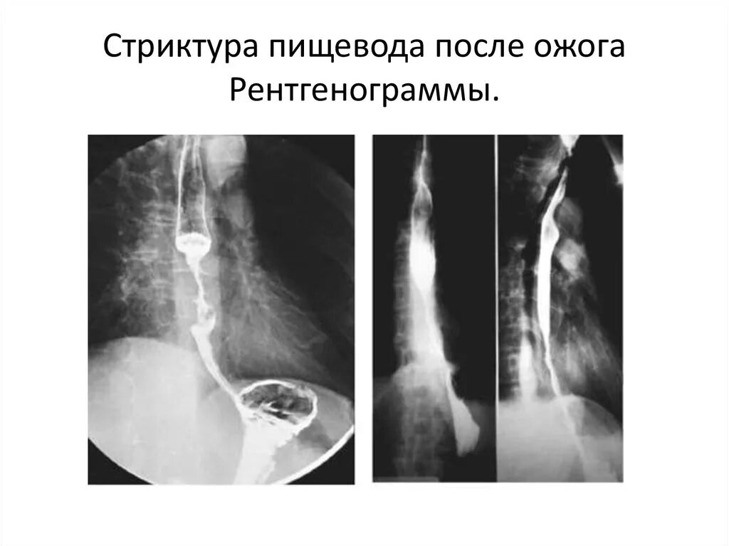 Рубцовые стриктуры пищевода. Рубцовая стриктура пищевода рентген. Послеожоговые стриктуры пищевода рентген. Рубцовый стеноз пищевода рентген. Рубцовые сужения пищевода