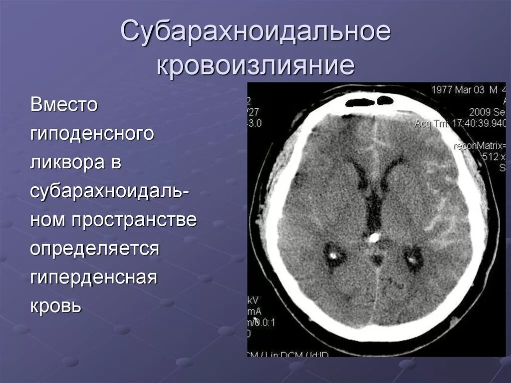 Травматическое субарахноидальное кровоизлияние кт. Субарахноидальное кровоизлияние головного мозга на кт. Субарахноидальное кровоизлияние инсульт кт. Субарахноидальное кровоизлияние кт картина.