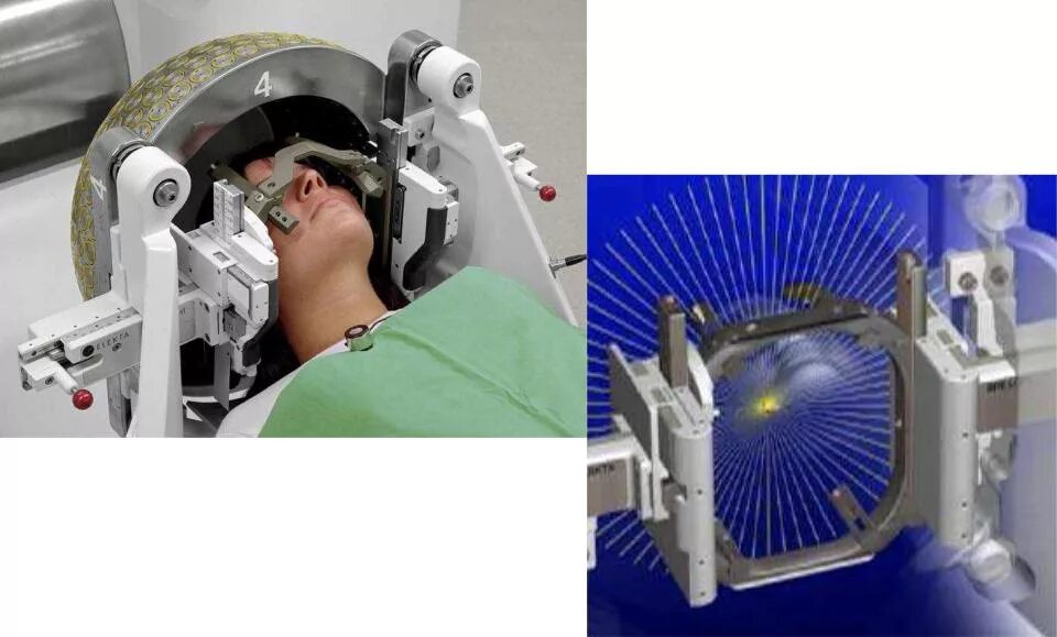 Компьютеризированный гамма нож. Бодо Липец гамма нож. Рентгеновская вспышка гамма нож. Сайт гамма нож