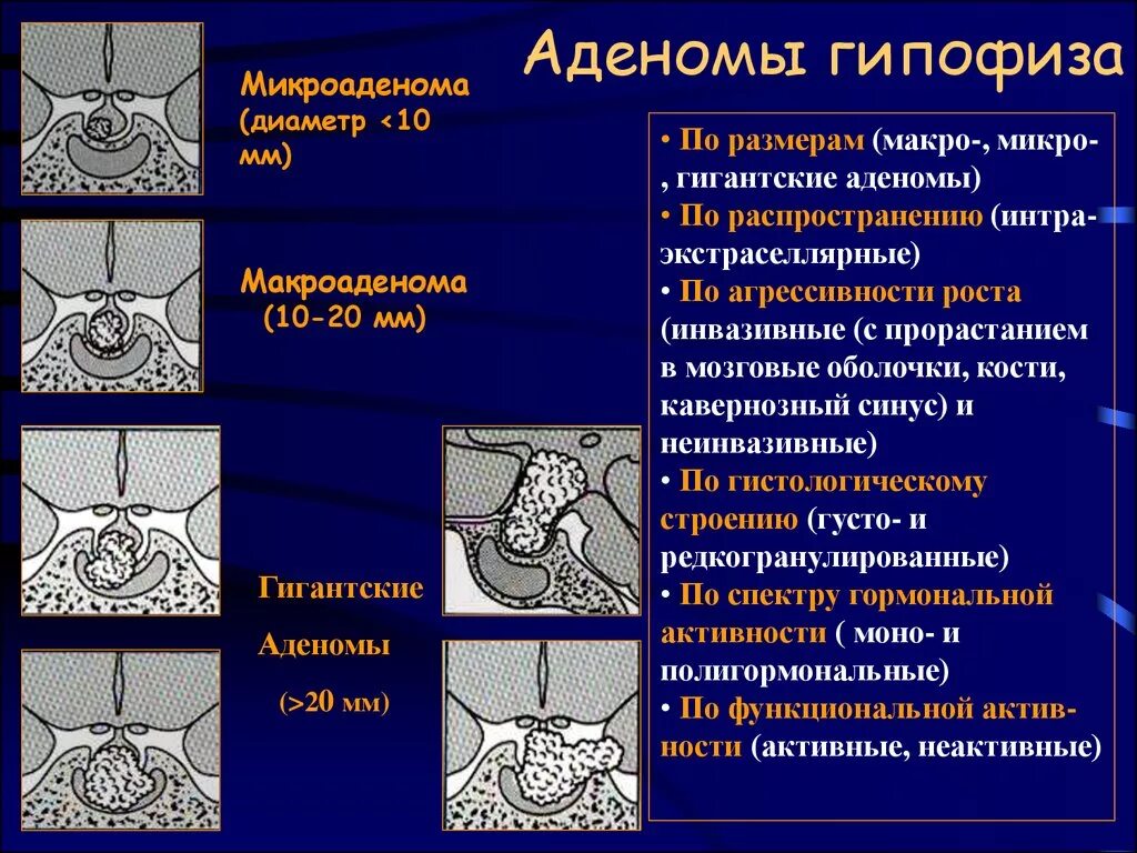 Микроаденома гипофиза что это у женщин. Пролактинома гипофиза мрт. Эндоселлярная аденома гипофиза головного мозга. Микроаденома гипофиза что это у женщин. Эндоселлярная аденома гипофиза головного мозга.