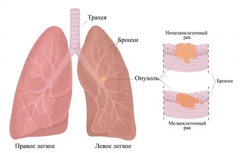 Pr легкого