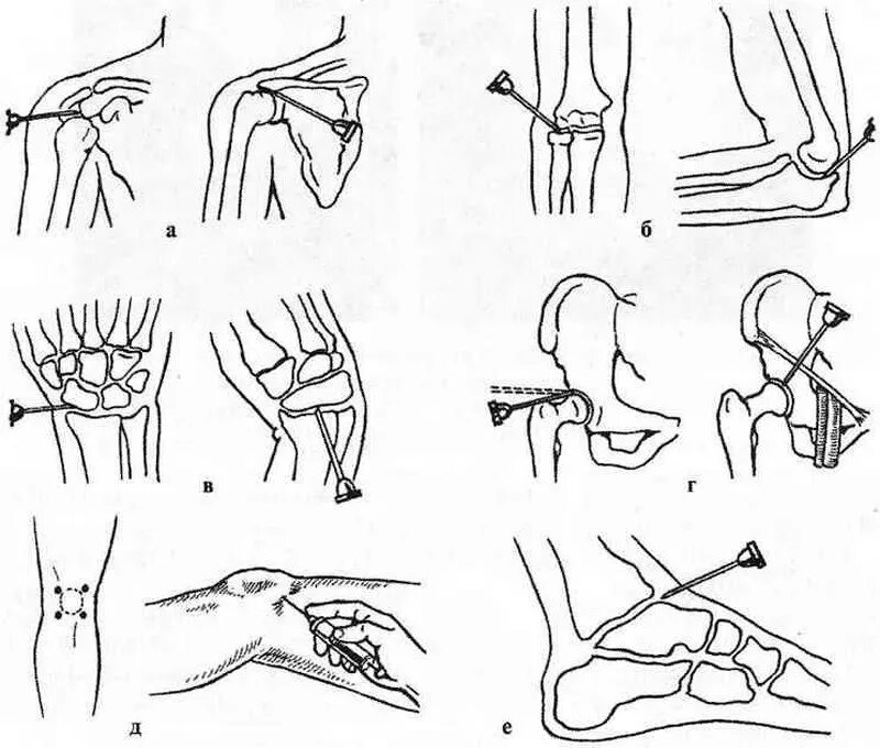 Как делают укол в коленный сустав. Пункция плечевого сустава схема. Пункция локтевого сустава схема. Внутрисуставные инъекции в плечевой сустав техника. Схема пункции лучезапястного сустава.