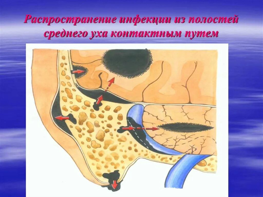 Отогенные осложнения. Отогенные внутричерепные осложнения ЛОР. Отогенный менингит. Отогенные абсцессы мозга. Отогенный сепсис.