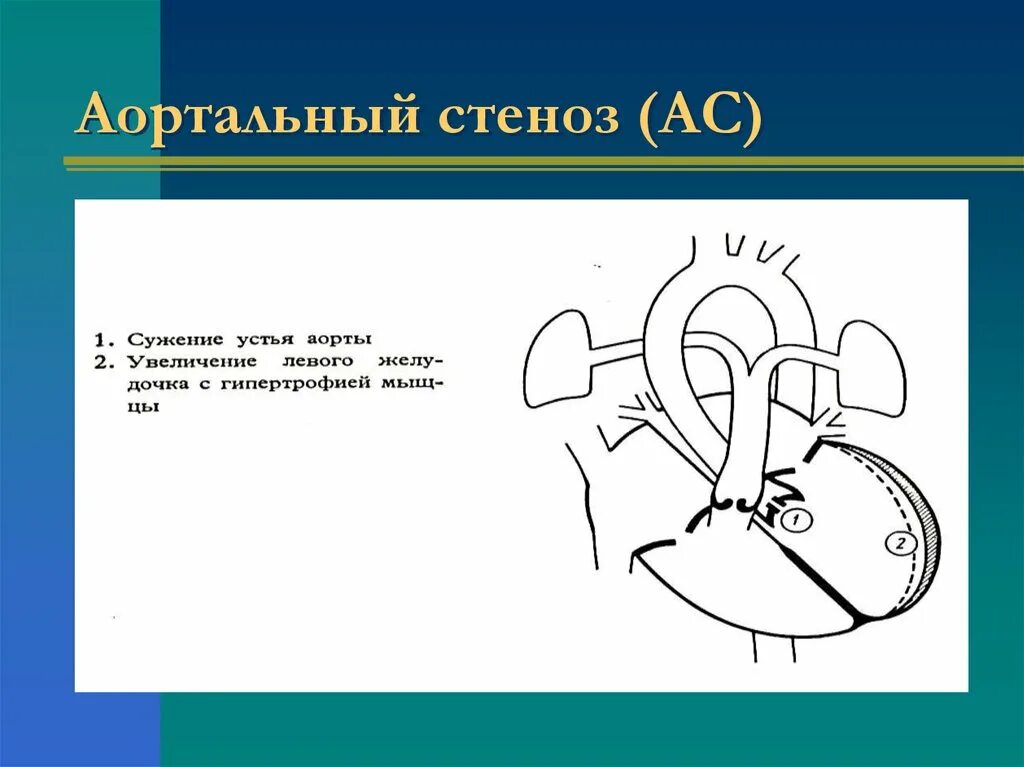 Аортальный стеноз что это такое. Стеноз устья аорты гемодинамика схема. Аортальный стеноз гемодинамика схема. Гемодинамика при аортальном стенозе схема. Патогенез аортального стеноза схема.