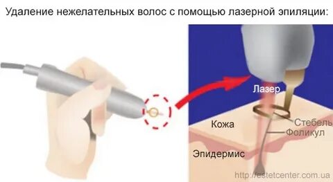 Какой лазер удаляет