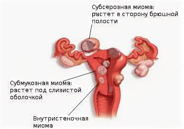 Множественная миома матки boleznimatki.com