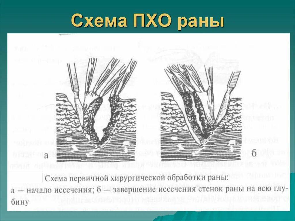 Пхо раны. Этапы обработки раны первичной хирургической обработки.