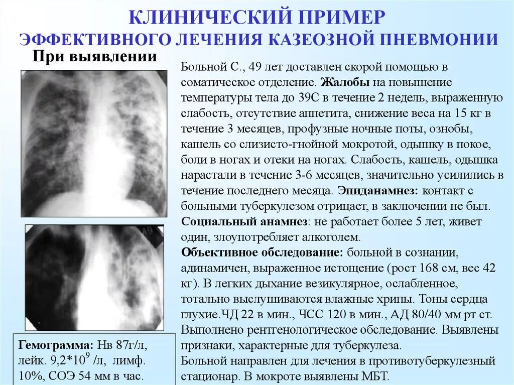 Лечение поражения легких