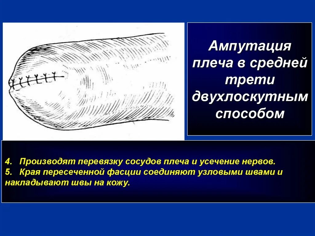 Лоскутная ампутация. Ампутация плеча в средней трети. Ампутация предплечья в нижней трети. Ампутация средней трети бедра. Ампутация на уровне средней трети бедра.