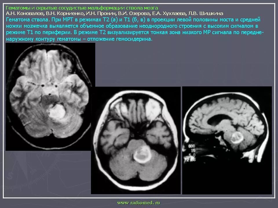 Астроцитома головного мозга в стволе. Гематома ствола мозга кт. Анапластическая астроцитома ствола мозга. Шваноима в головном мозге.