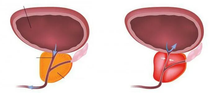 Бактерии простаты. Простата у пожилых мужчин. Проблемы с мочеиспусканием у мужчин. Мочевинная железа где находится. Лечение хронического бактериального простатита.