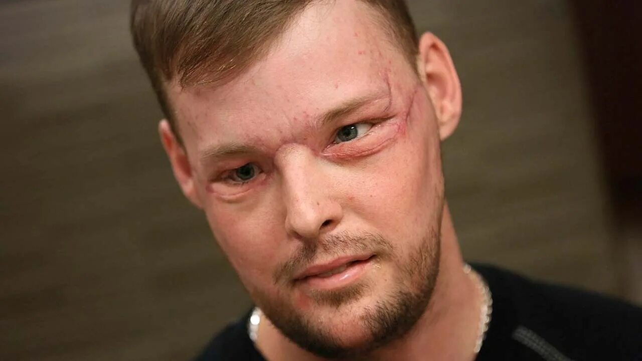Firefighter who had the world's most extensive face transplant says he'd run int