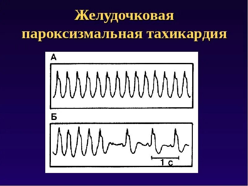 Какой ритм при пароксизмальной тахикардии. Желудочковая тахикардия заключение экг. пароксизмальная желудочковая тахикардия. пароксизмальная желудочковая тахикардия на экг. желудочковая форма пароксизмальной тахикардии.