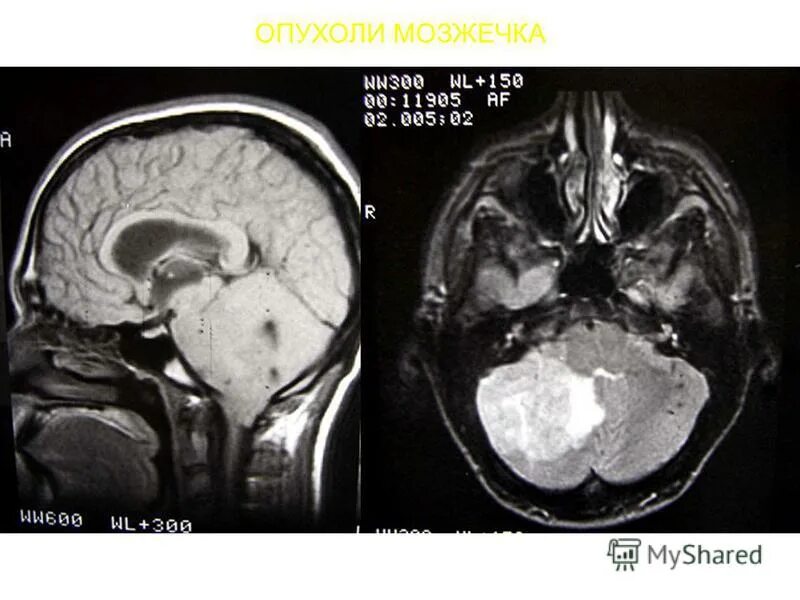 опухоль мозжечка операция. гемангиобластома мозга. опухоль мозжечка операция. астроцитома мозжечка мрт. образование левой гемисферы мозжечка.