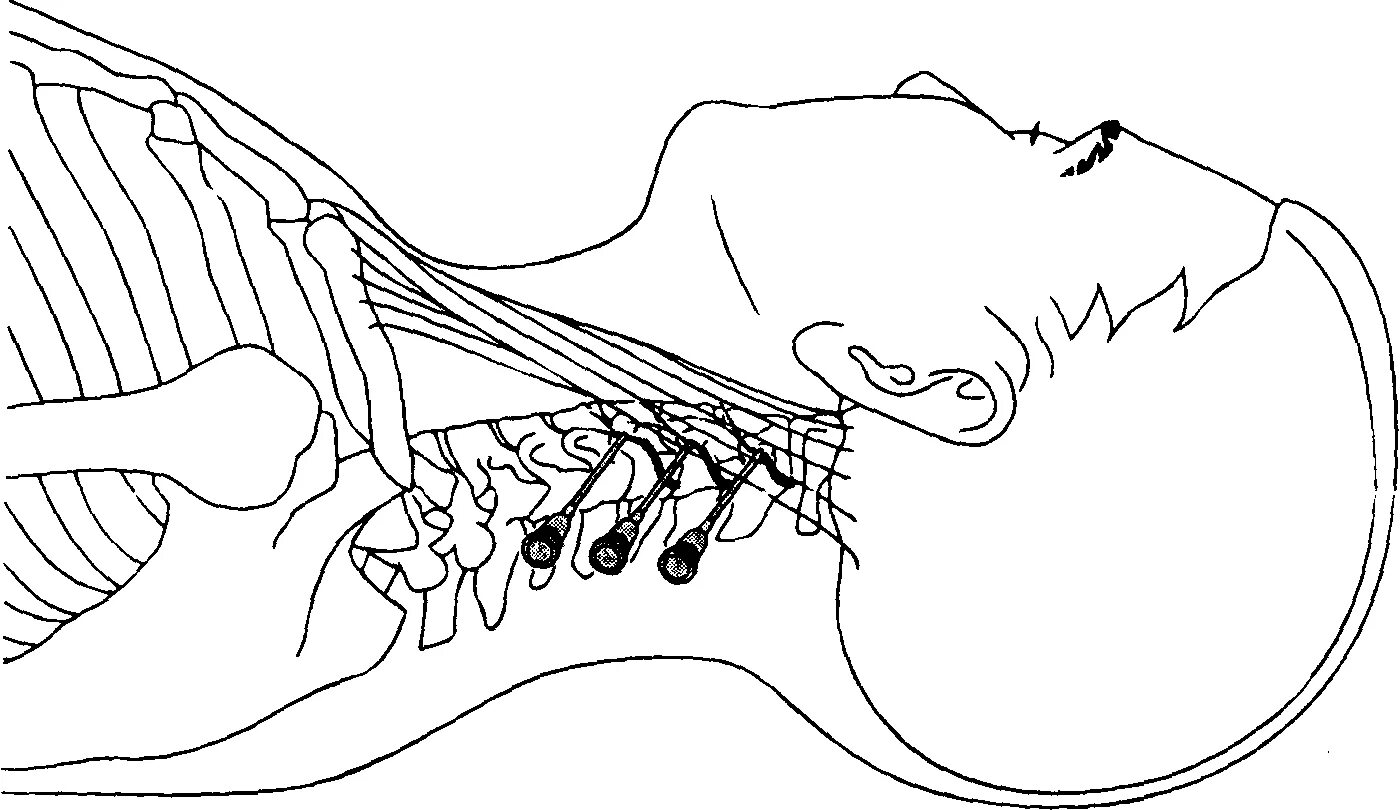Блокада техника выполнения. Паравертебральная новокаиновая блокада показания. Паравертебральные блокады шейного отдела. Новокаиновая блокада шейного отдела.
