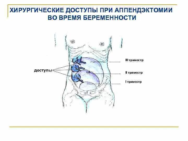 Боли в животе при остром аппендиците. Острого аппендицита у беременных хирургические доступы. Хирургические доступы при остром аппендиците. Расположение аппендицита. Расположение аппендикса при беременности.